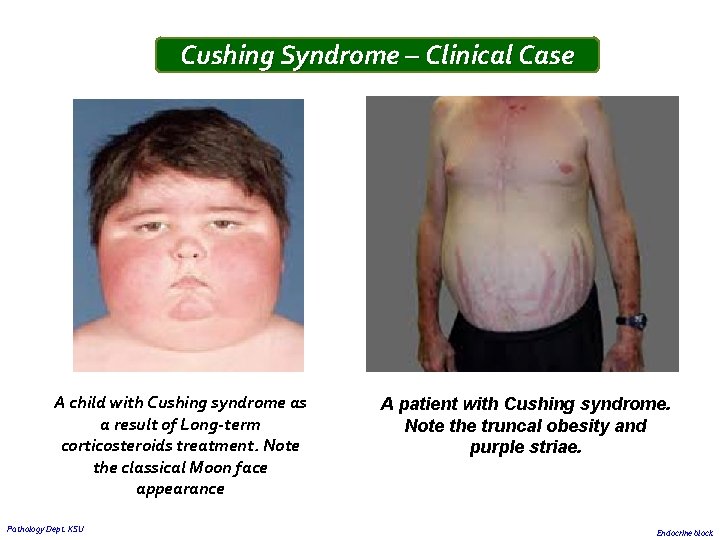 Cushing Syndrome – Clinical Case A child with Cushing syndrome as a result of