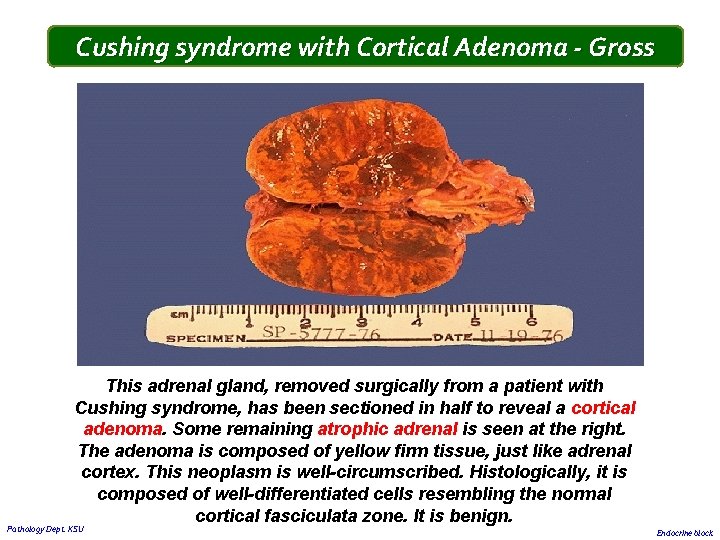 Cushing syndrome with Cortical Adenoma - Gross This adrenal gland, removed surgically from a