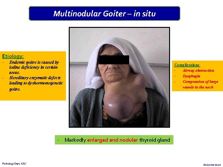Multinodular Goiter – in situ Etiology: - Endemic goitre is caused by iodine deficiency