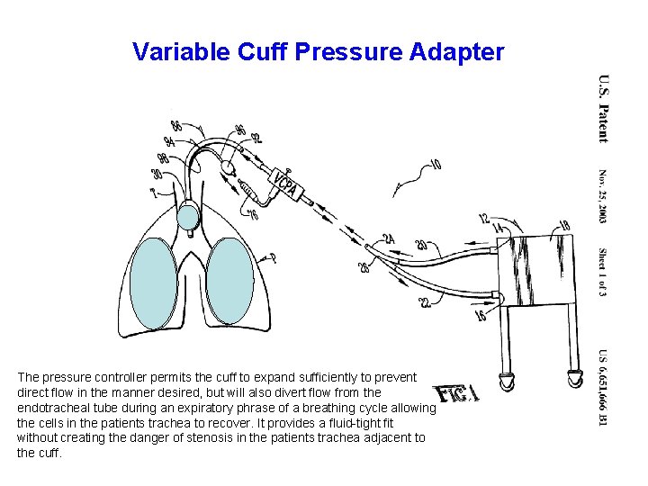 Variable Cuff Pressure Adapter The pressure controller permits the cuff to expand sufficiently to