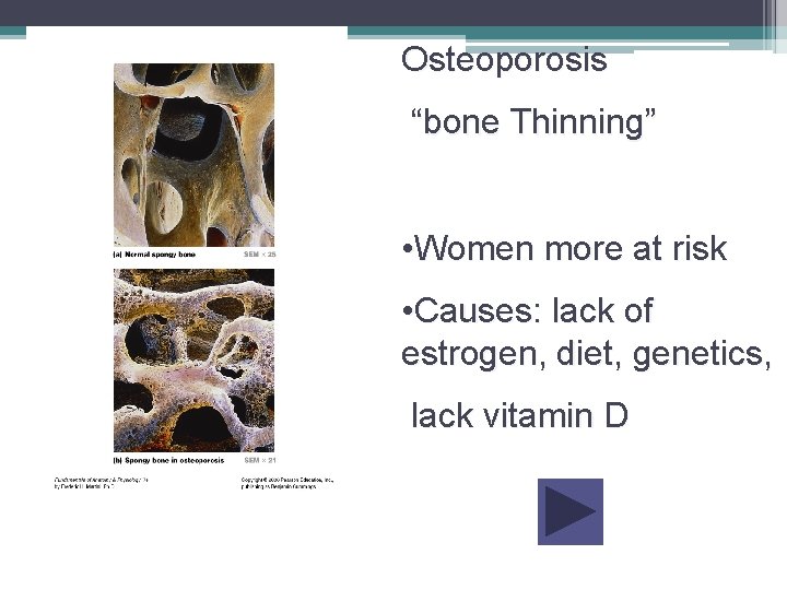 Osteoporosis “bone Thinning” • Women more at risk • Causes: lack of estrogen, diet,