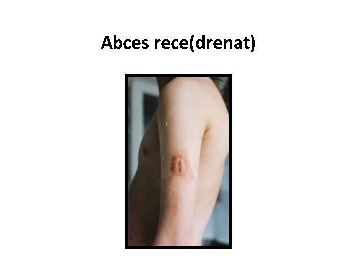 Abces rece(drenat) 