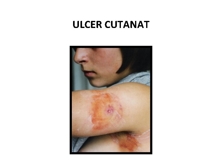 ULCER CUTANAT 