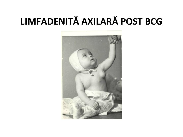 LIMFADENITĂ AXILARĂ POST BCG 