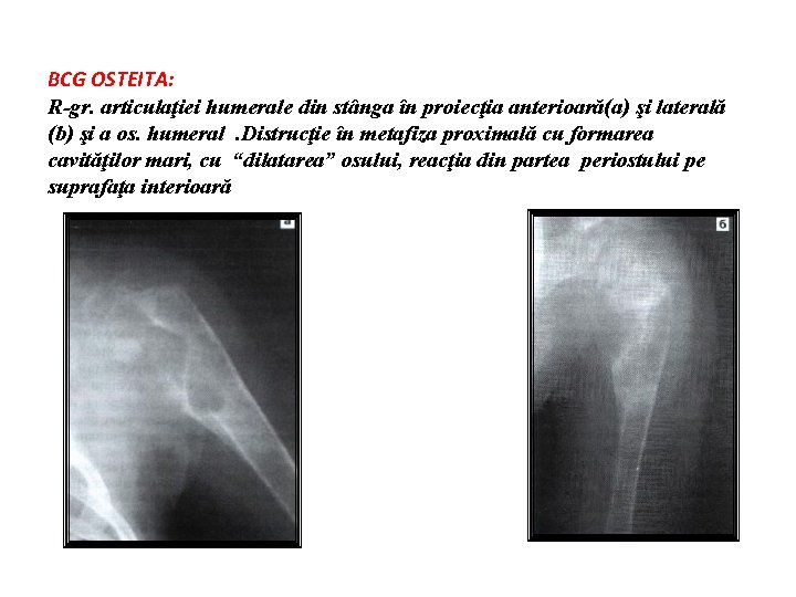 BCG OSTEITA: R-gr. articulaţiei humerale din stânga în proiecţia anterioară(a) şi laterală (b) şi