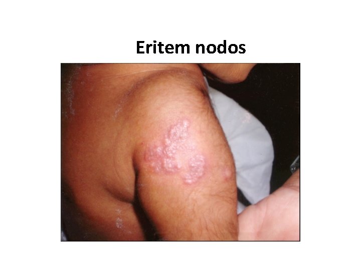 Eritem nodos 