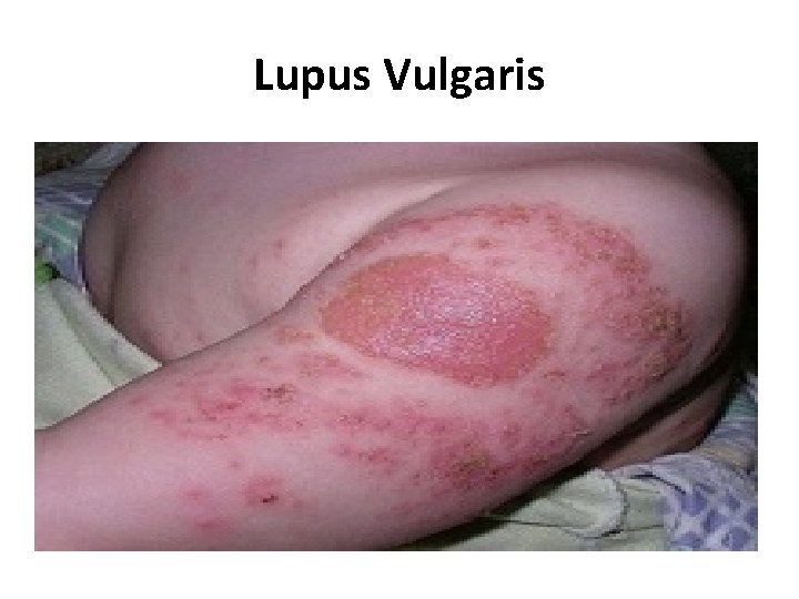 Lupus Vulgaris 