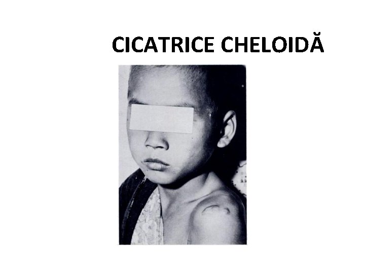 CICATRICE CHELOIDĂ 