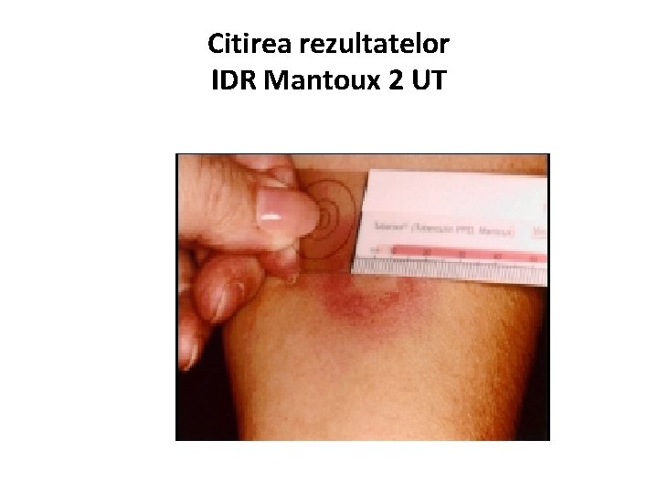 Citirea rezultatelor IDR Mantoux 2 UT 