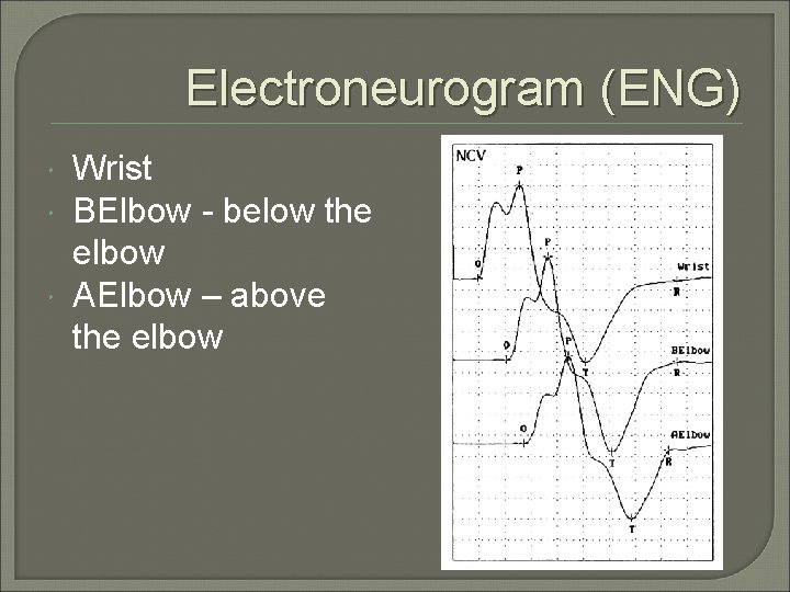 Electroneurogram (ENG) Wrist BElbow - below the elbow AElbow – above the elbow 