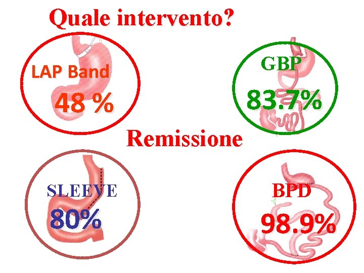 Quale intervento? GBP LAP Band 83. 7% 48 % Remissione SLEEVE 80% BPD 98.