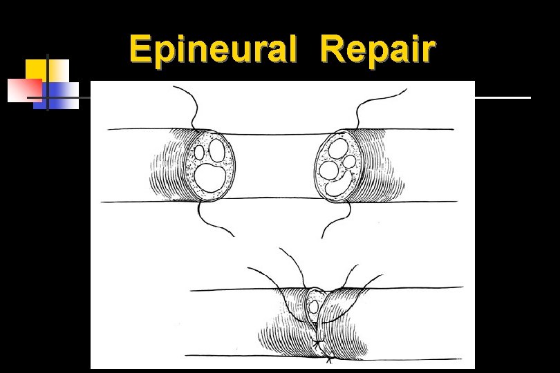 Epineural Repair 