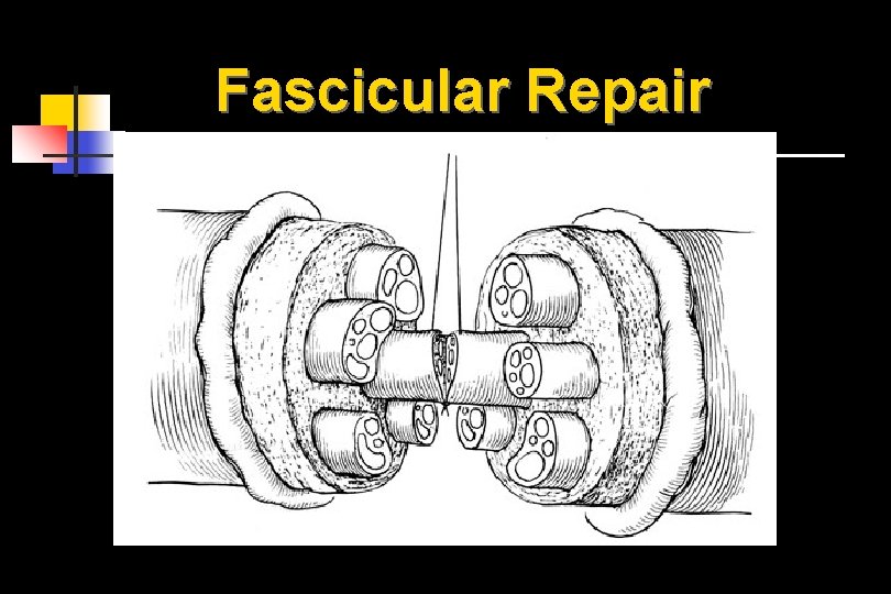 Fascicular Repair 
