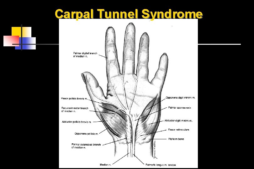Carpal Tunnel Syndrome 