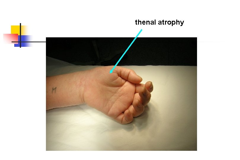 thenal atrophy 
