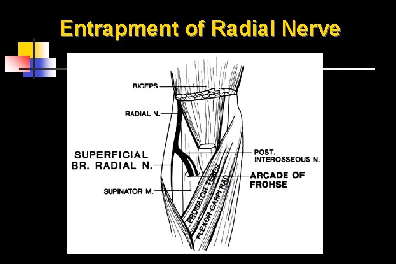 Entrapment of Radial Nerve 