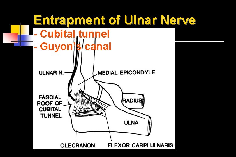 Entrapment of Ulnar Nerve - Cubital tunnel - Guyon’s canal 