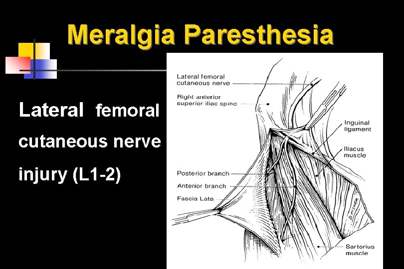 Meralgia Paresthesia Lateral femoral cutaneous nerve injury (L 1 -2) 