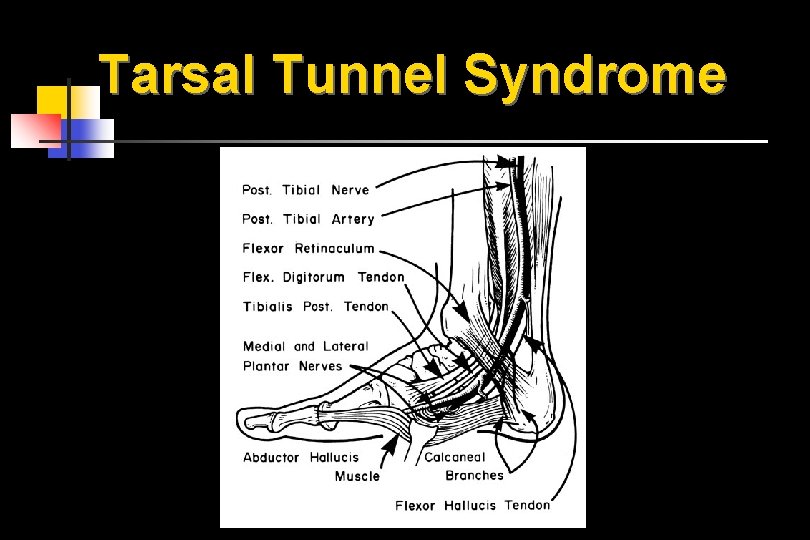 Tarsal Tunnel Syndrome 