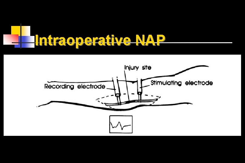 Intraoperative NAP 