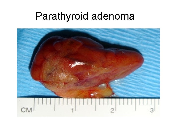 Parathyroid adenoma 