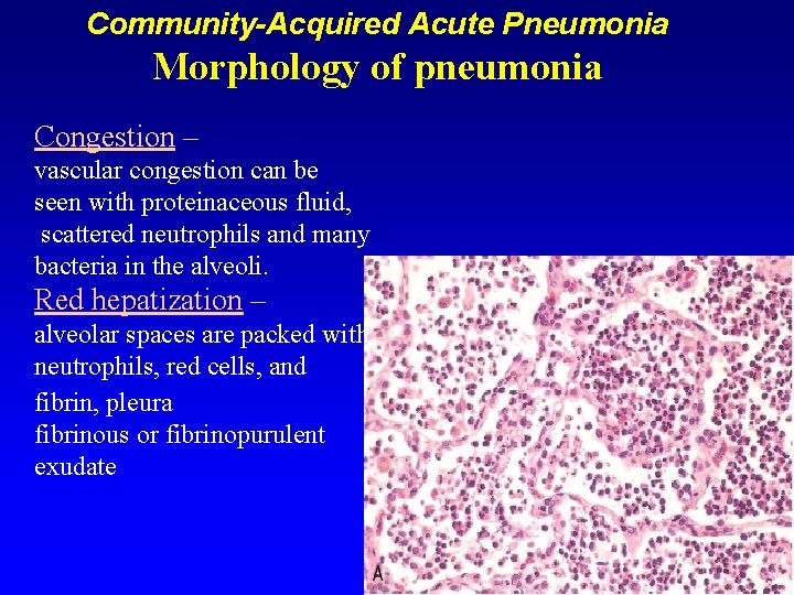 Community-Acquired Acute Pneumonia Morphology of pneumonia Congestion – vascular congestion can be seen with
