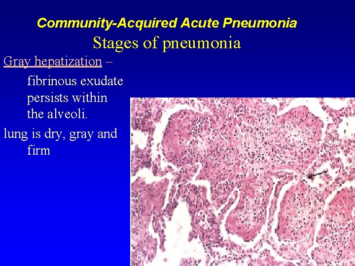 Community-Acquired Acute Pneumonia Stages of pneumonia Gray hepatization – fibrinous exudate persists within the