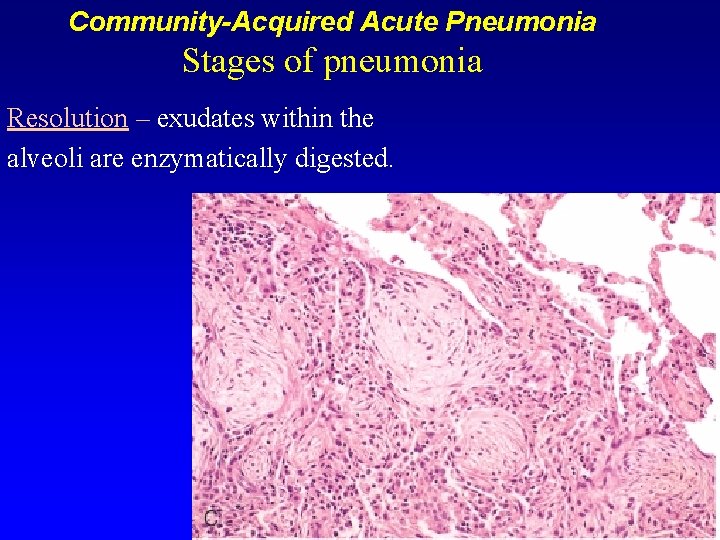 Community-Acquired Acute Pneumonia Stages of pneumonia Resolution – exudates within the alveoli are enzymatically