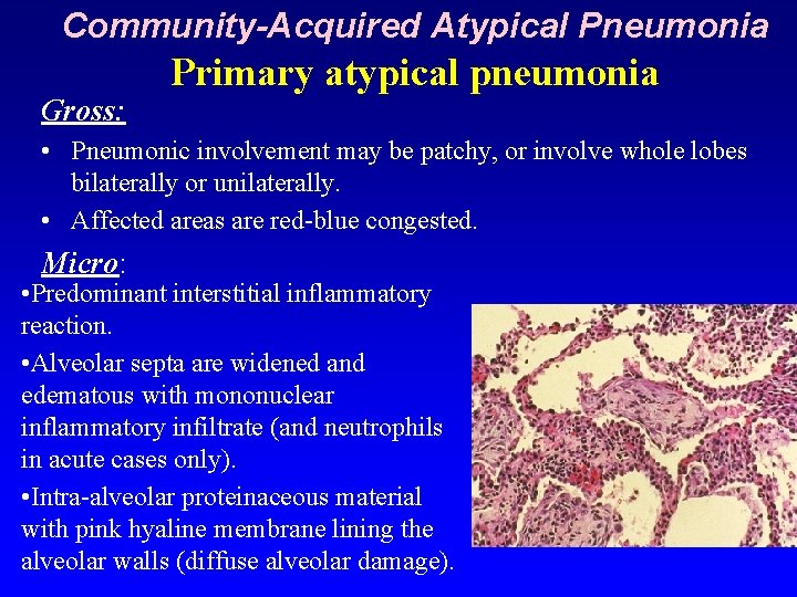 Community-Acquired Atypical Pneumonia Gross: Primary atypical pneumonia • Pneumonic involvement may be patchy, or