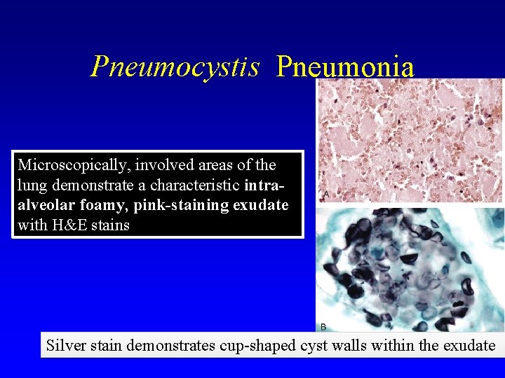 Pneumocystis Pneumonia Microscopically, involved areas of the lung demonstrate a characteristic intraalveolar foamy, pink-staining