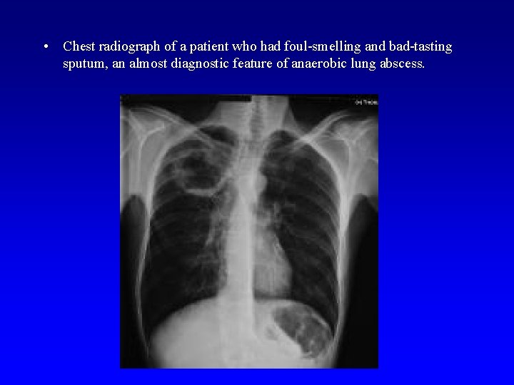  • Chest radiograph of a patient who had foul-smelling and bad-tasting sputum, an