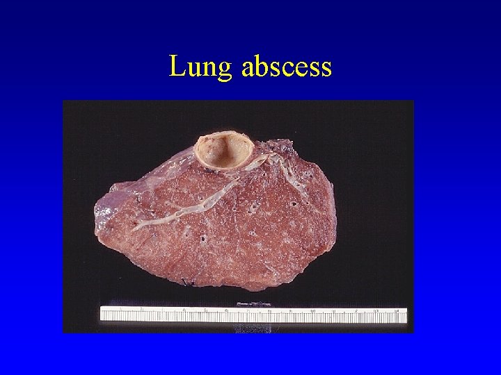 Lung abscess 