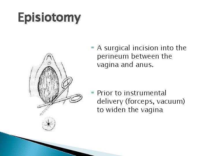 Episiotomy A surgical incision into the perineum between the vagina and anus. Prior to