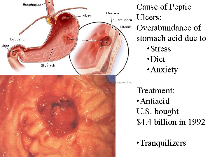 Cause of Peptic Ulcers: Overabundance of stomach acid due to • Stress • Diet