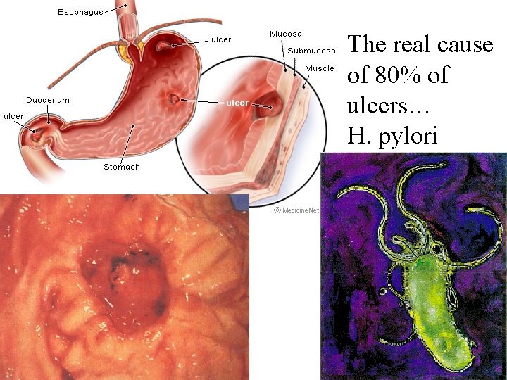 The real cause of 80% of ulcers… H. pylori 