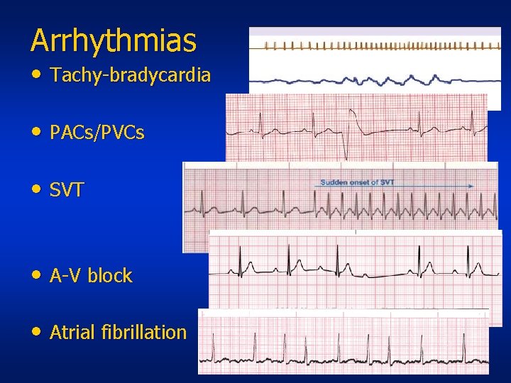 Arrhythmias • Tachy-bradycardia • PACs/PVCs • SVT • A-V block • Atrial fibrillation 