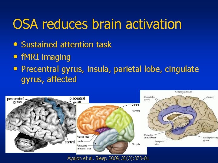 OSA reduces brain activation • Sustained attention task • f. MRI imaging • Precentral