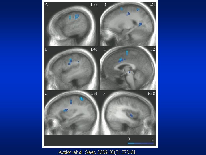 Ayalon et al. Sleep 2009; 32(3): 373 -81 