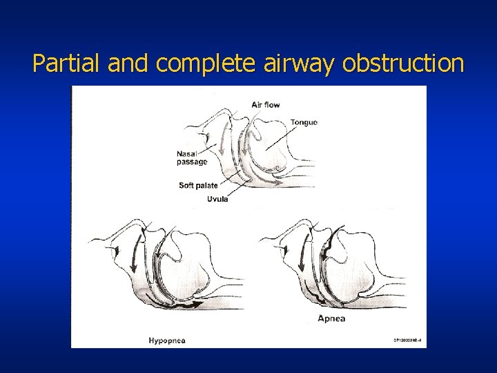 Partial and complete airway obstruction 