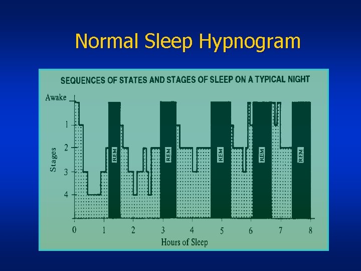 Normal Sleep Hypnogram 