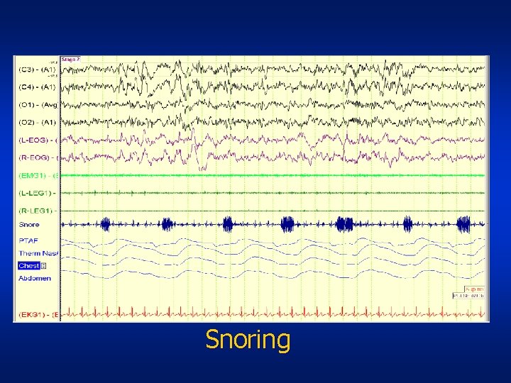 Snoring 
