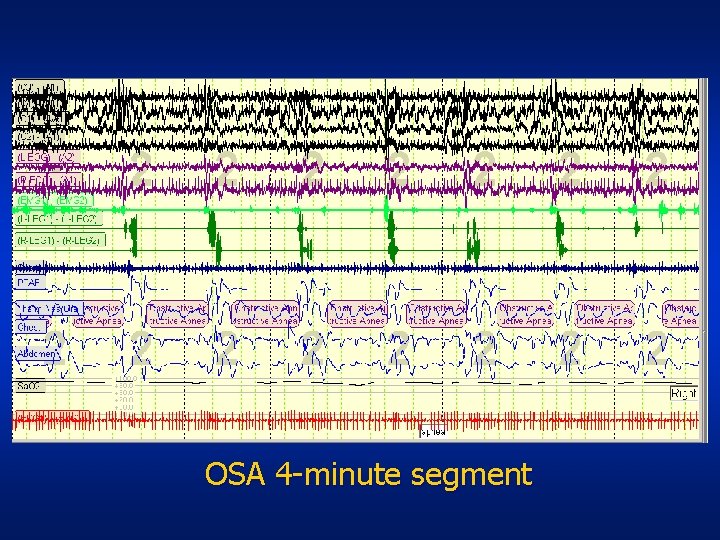 OSA 4 -minute segment 