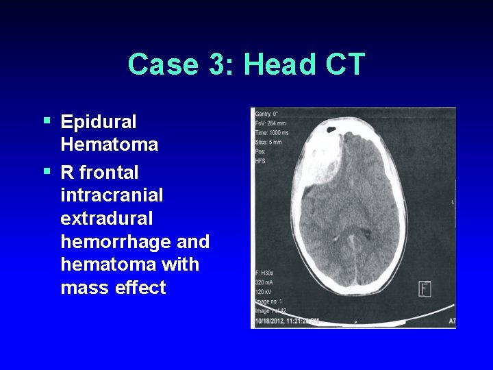 Case 3: Head CT § Epidural Hematoma § R frontal intracranial extradural hemorrhage and