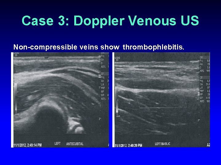 Case 3: Doppler Venous US Non-compressible veins show thrombophlebitis. 