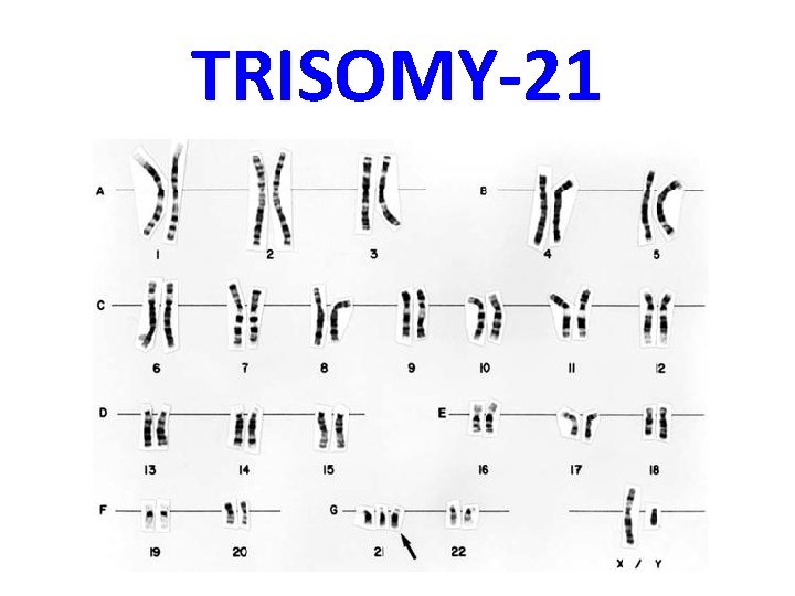 TRISOMY-21 