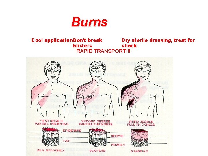 Burns Cool application Don’t break blisters Dry sterile dressing, treat for shock RAPID TRANSPORT!!!