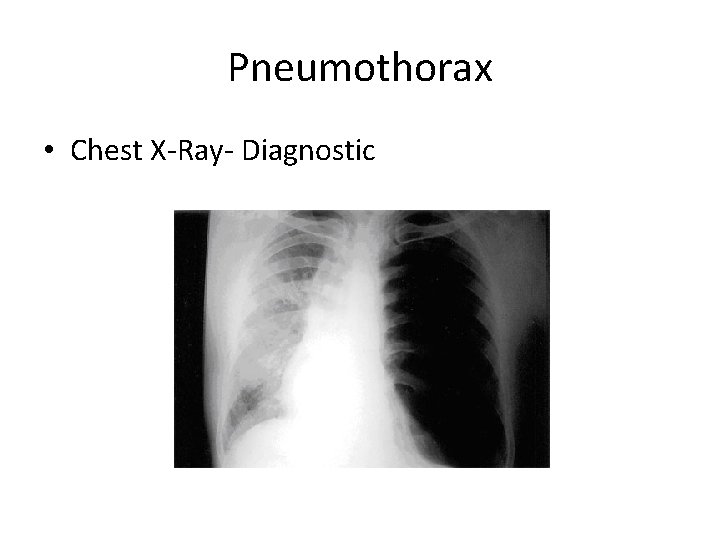 Pneumothorax • Chest X-Ray- Diagnostic 