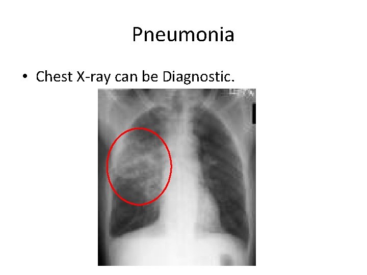 Pneumonia • Chest X-ray can be Diagnostic. 