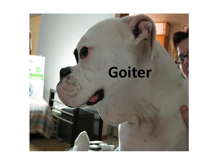 Goiter Goiter