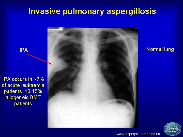Invasive pulmonary aspergillosis IPA Normal lung IPA occurs in ~7% of acute leukaemia patients,